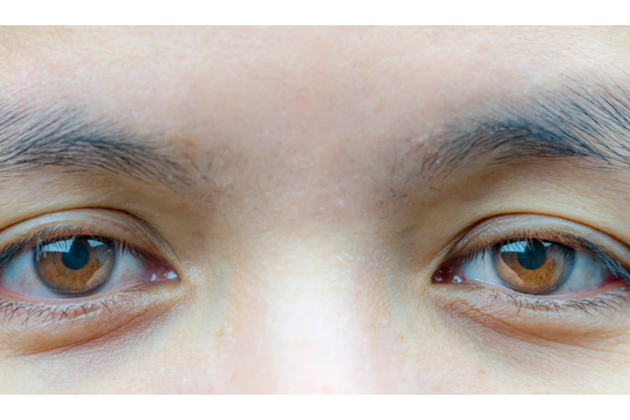 What Is Ptosis And How Can It Be Fixed?