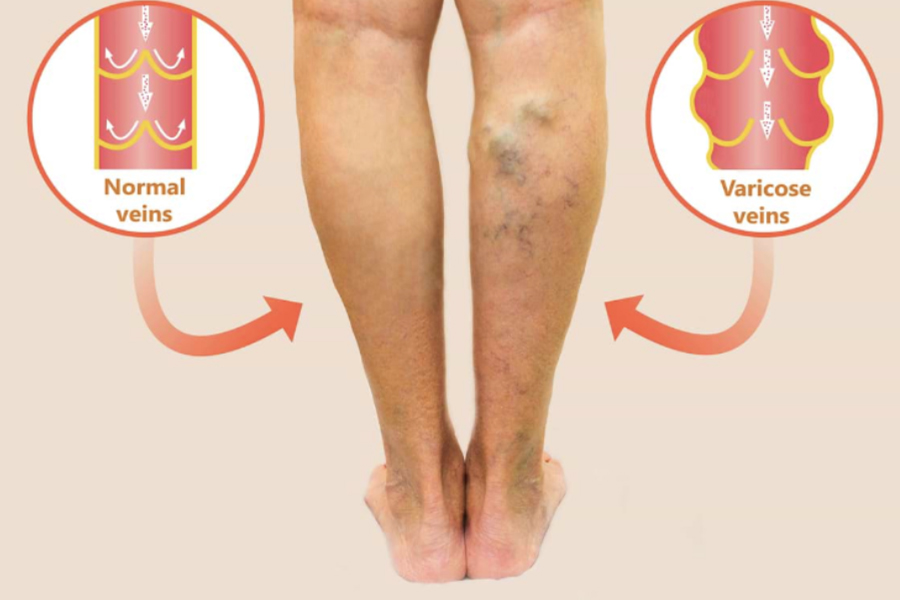 Understanding Varicose Veins: Causes, Symptoms, And Thermal Ablation Solutions