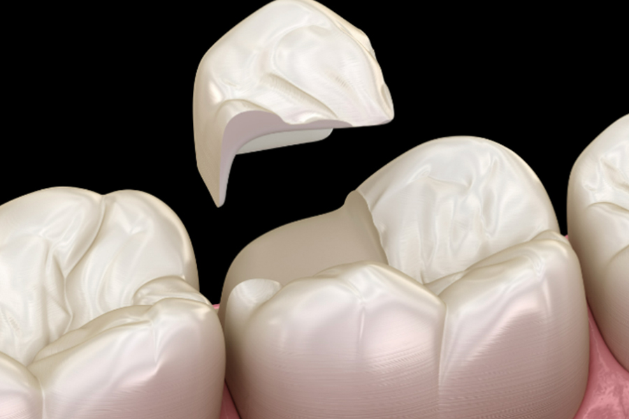 The Importance of Tooth Crown Maintenance Tips for Longevity