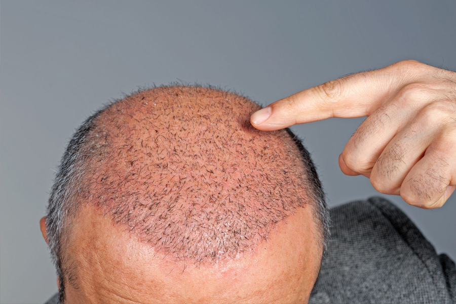Is Hair Restoration The Most Appropriate Solution For Pattern Baldness
