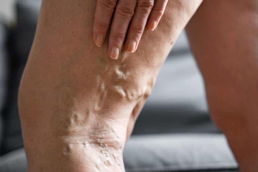 5 Common Misconceptions About Varicose Veins Treatment in Singapore