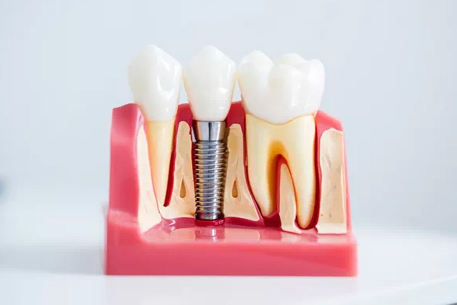 Dental Implants Gain Your Smile and Confidence Again