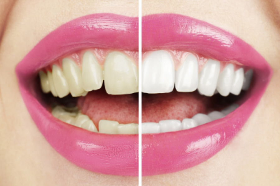 Cosmetic Dental Treatments that Transform the Look of Your Smile