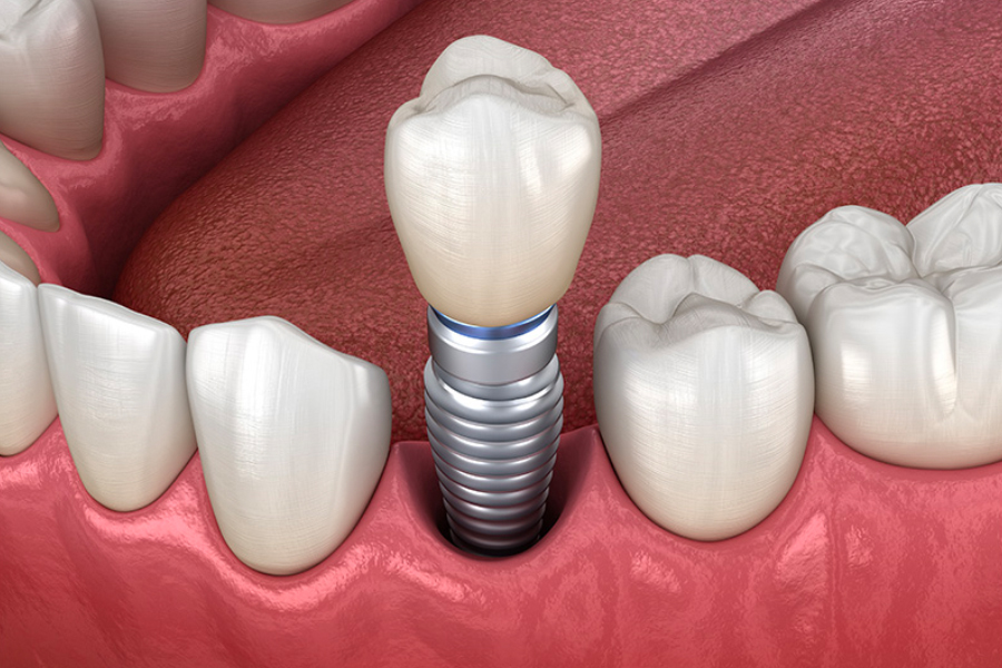 Dental Implant, New Dentistry Method with Surprising Result