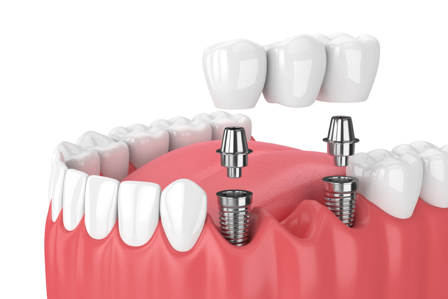 The Main Differences Between Dental Implants & Dental Bridges