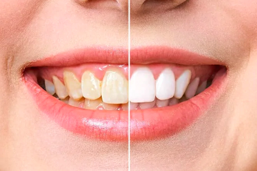 What Makes Veneers An Appropriate Solution For Whiter Teeth? 
