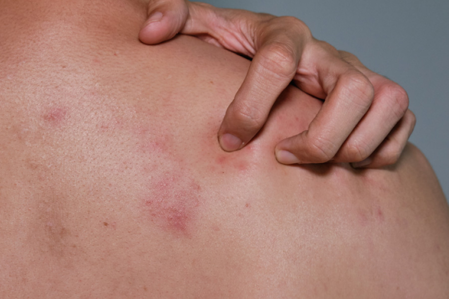 Shingles Symptoms, Risks, and Why Vaccination Matters in the Philippines